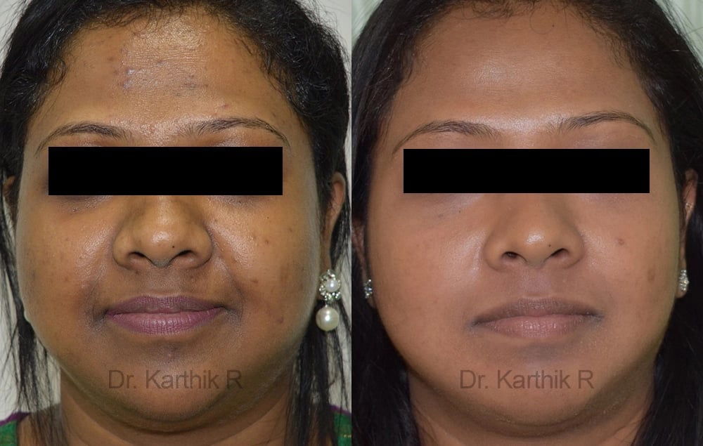 chemical peels microdermabrasion before and after photo by chennai plastic surgery in india