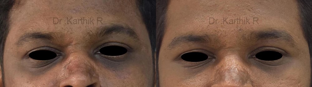 chemical peels microdermabrasion before and after photo by chennai plastic surgery in india
