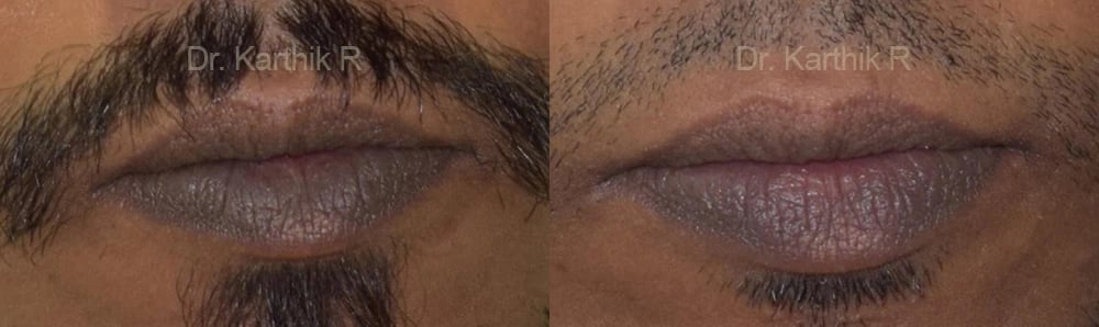 chemical peels microdermabrasion before and after photo by chennai plastic surgery in india