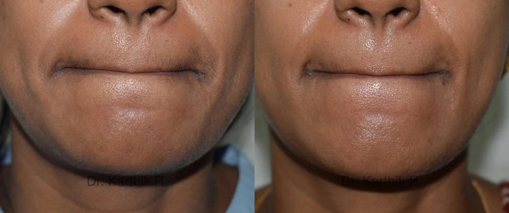 laser hair reduction before and after photo by chennai plastic surgery in india