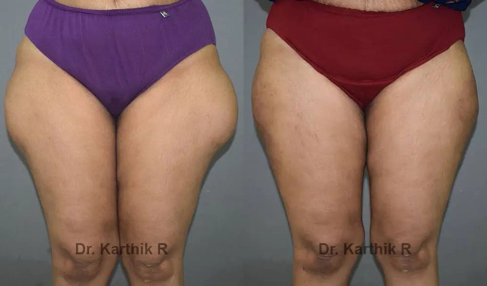 liposuction thighs before and after photo by chennai plastic surgery in india