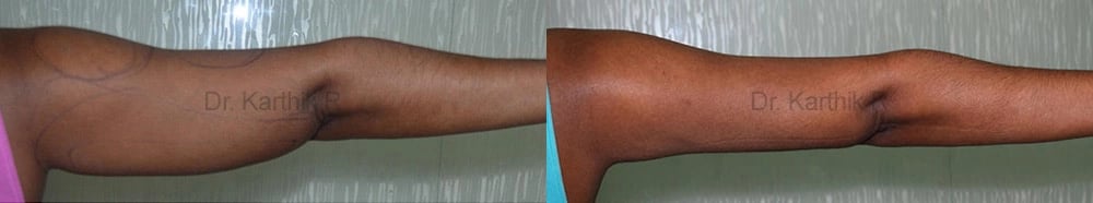 liposuction arms arm tuck before and after photo by chennai plastic surgery in india