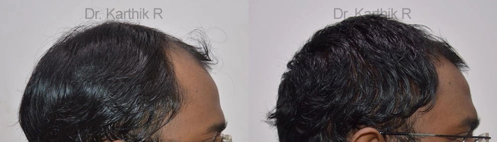 hair transplantation before and after photo by chennai plastic surgery in india