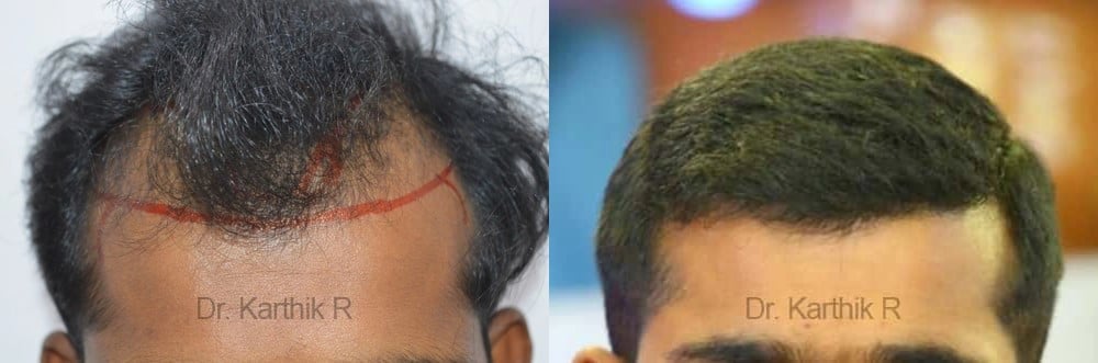 hair transplantation before and after photo by chennai plastic surgery in india