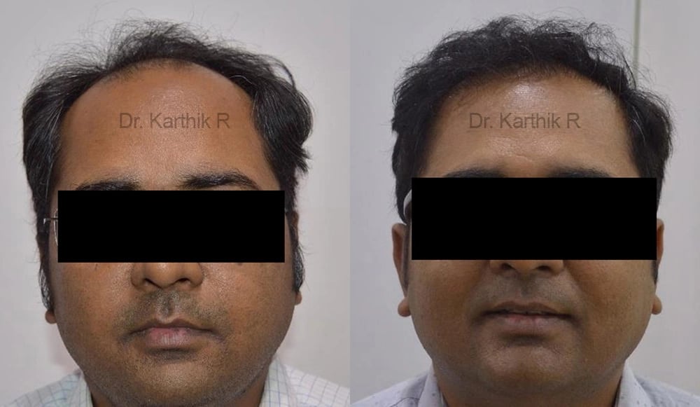 hair transplantation before and after photo by chennai plastic surgery in india