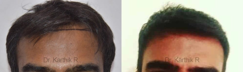 hair transplantation before and after photo by chennai plastic surgery in india