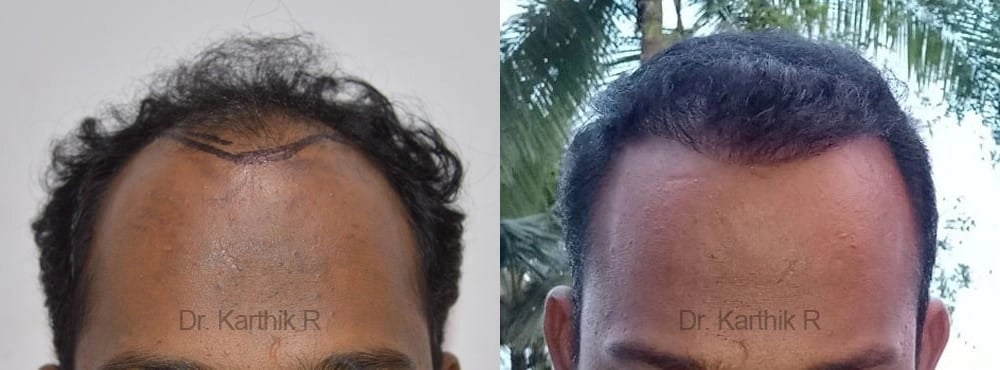 hair transplantation before and after photo by chennai plastic surgery in india
