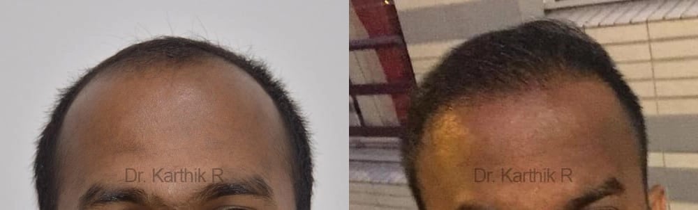 hair transplantation before and after photo by chennai plastic surgery in india