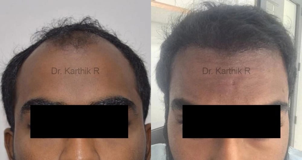 hair transplantation before and after photo by chennai plastic surgery in india