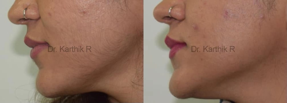 laser hair reduction before and after photo by chennai plastic surgery in india