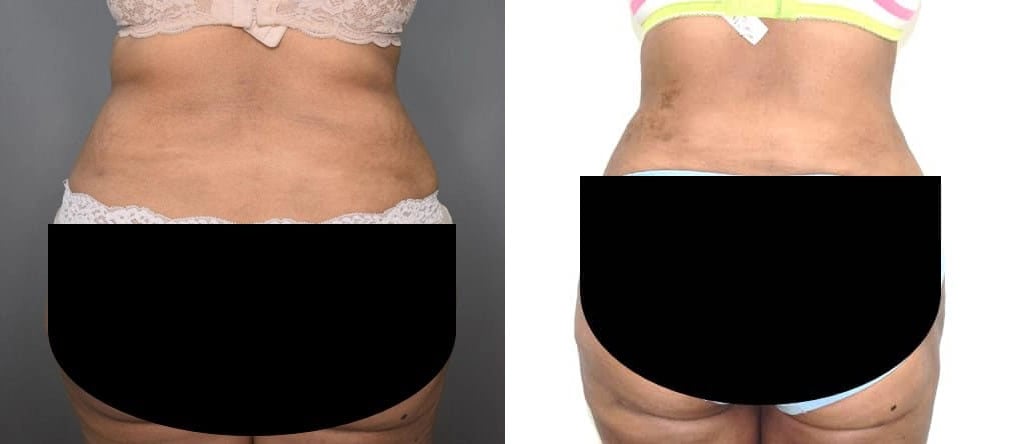 vaser liposuction before and after photo by chennai plastic surgery in india