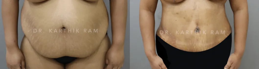 tummy tuck before and after photo by chennai plastic surgery in india