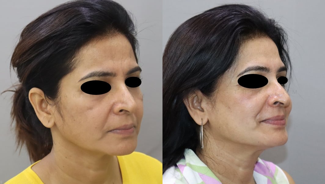 dermal fillers before and after photo by chennai plastic surgery in india