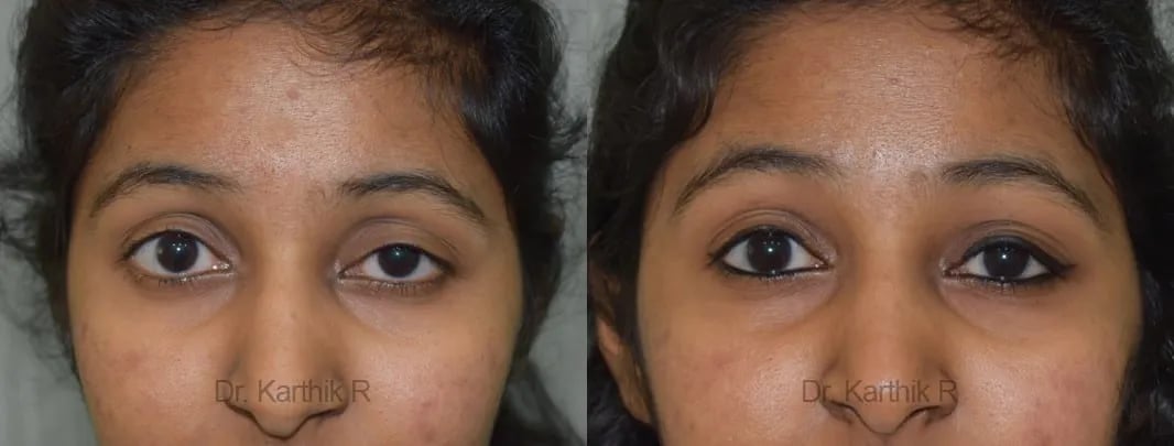 blepharoplasty before and after photo by chennai plastic surgery in india