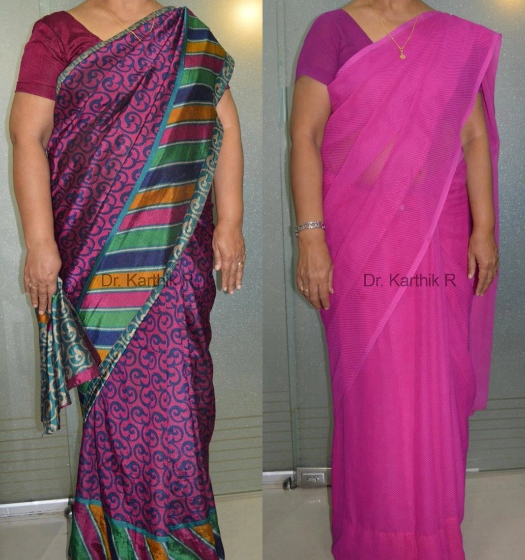 weight loss program before and after photo by chennai plastic surgery in india