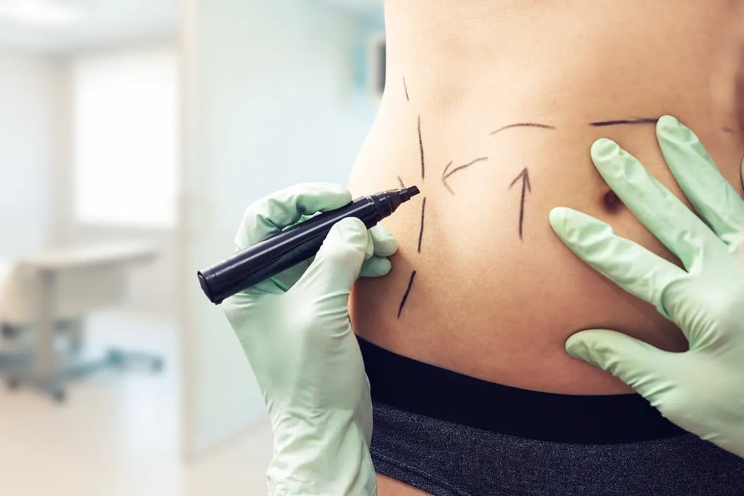 Is Liposuction right for you?