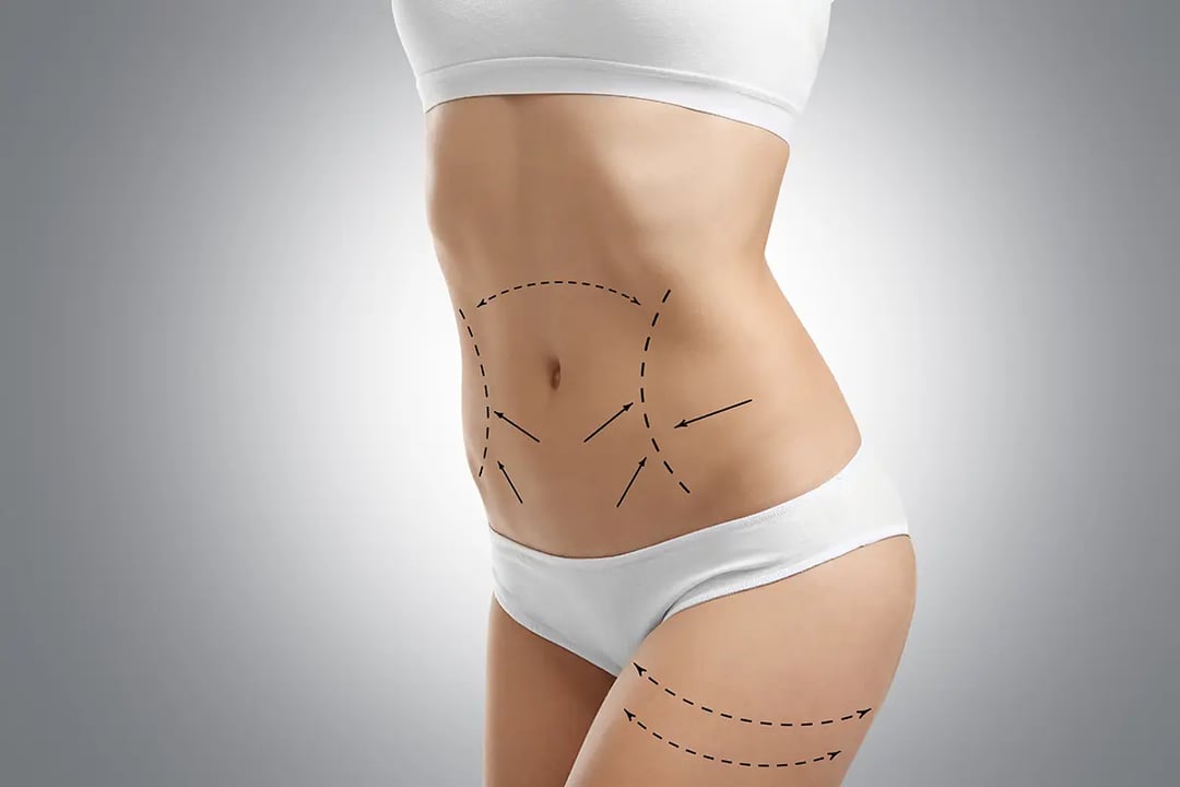 Look, its Liposuction