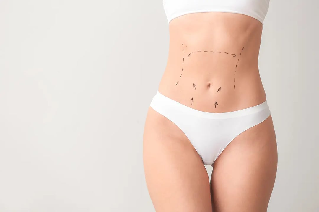 Tummy Tuck: Abdominoplasty Chennai Body Surgery