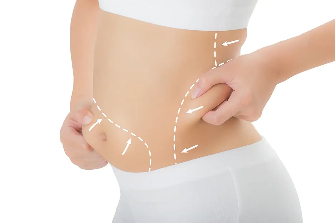 Body Beautiful: Liposuction comes to the rescue