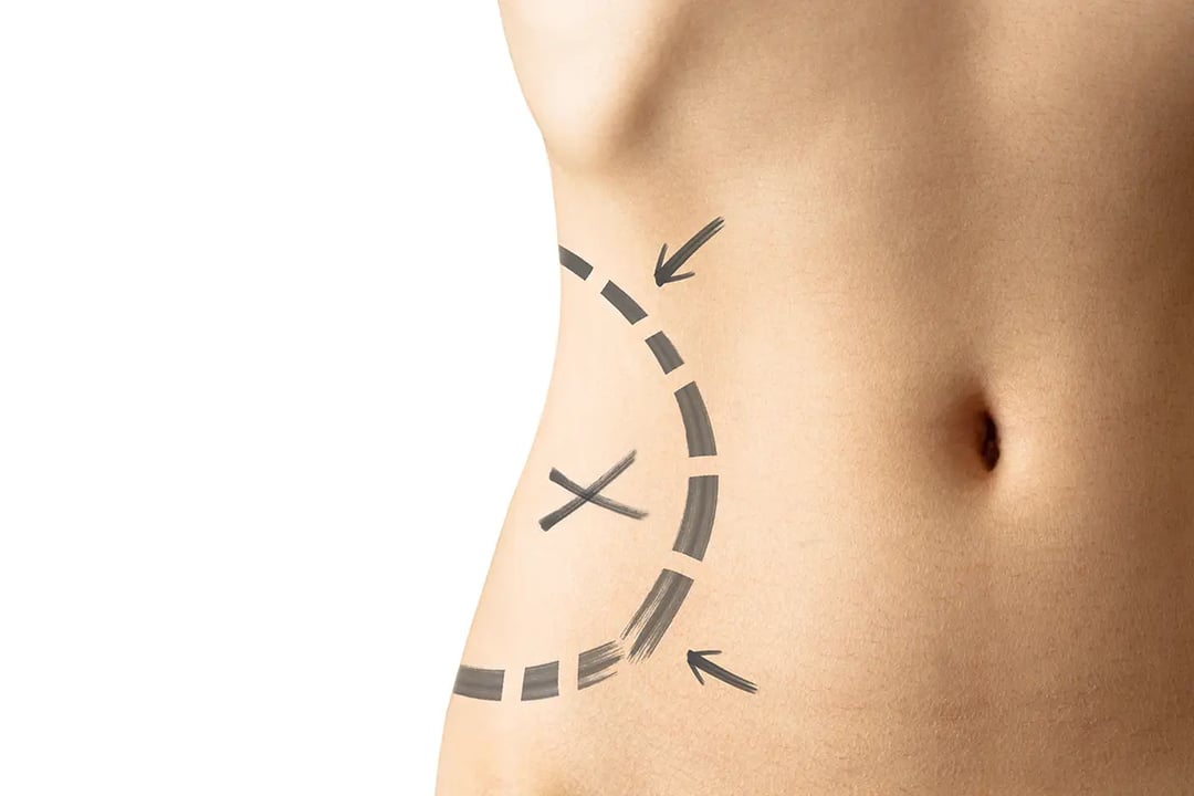 Complications of Liposuction