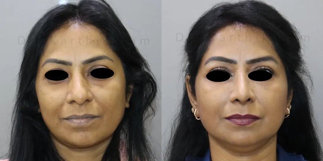 rhinoplasty before and after photo by chennai plastic surgery in india