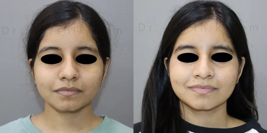 rhinoplasty before and after photo by chennai plastic surgery in india