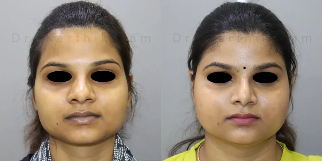 rhinoplasty before and after photo by chennai plastic surgery in india