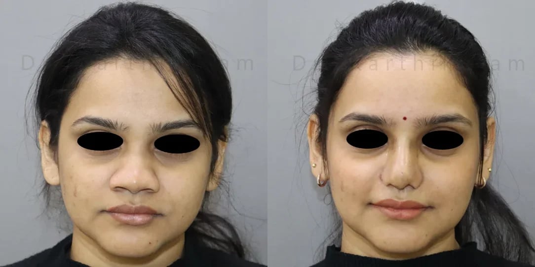 rhinoplasty before and after photo by chennai plastic surgery in india