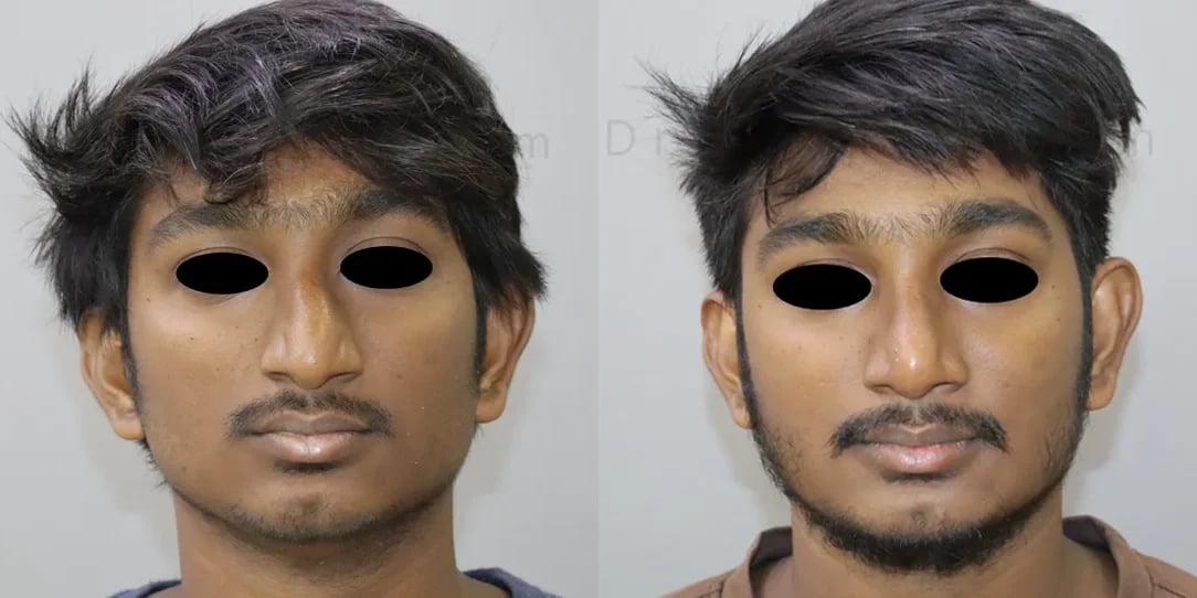 rhinoplasty before and after photo by chennai plastic surgery in india