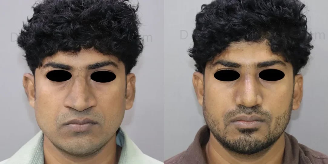 rhinoplasty before and after photo by chennai plastic surgery in india