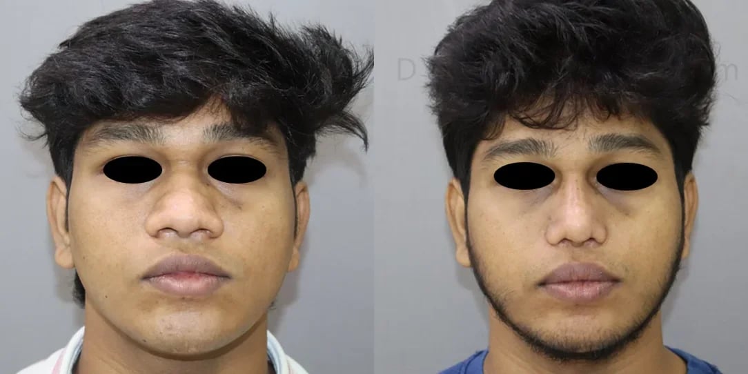 rhinoplasty before and after photo by chennai plastic surgery in india