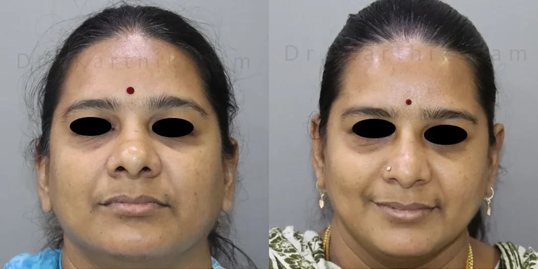 rhinoplasty before and after photo by chennai plastic surgery in india
