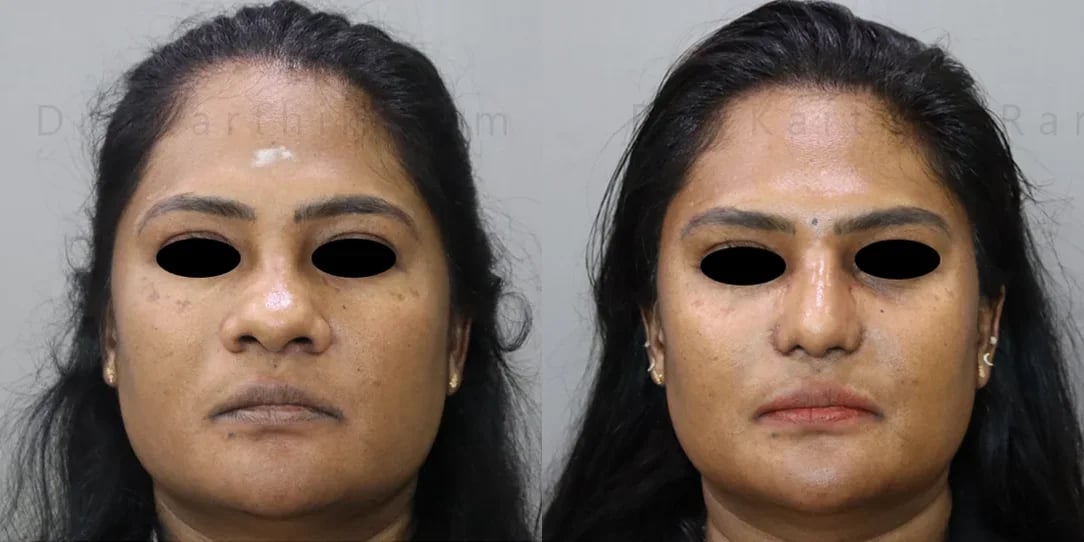 rhinoplasty before and after photo by chennai plastic surgery in india