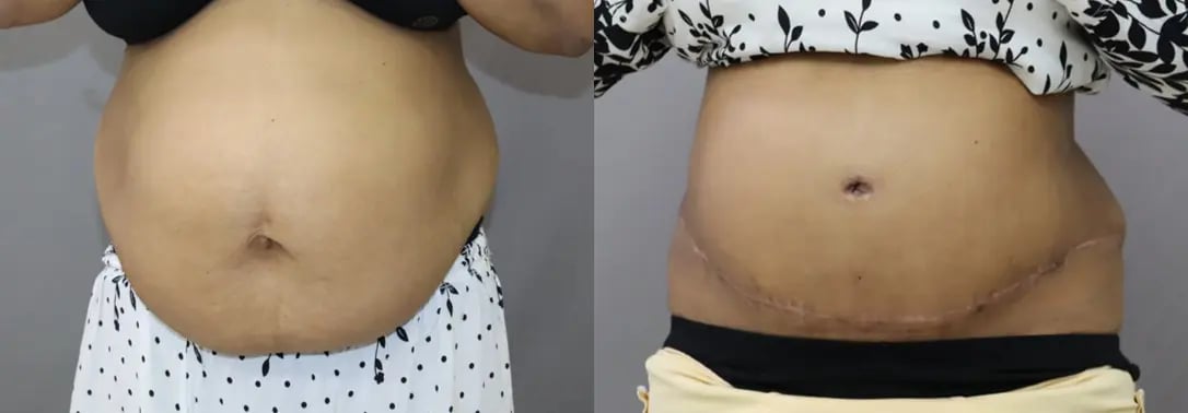 tummy tuck before and after photo by chennai plastic surgery in india