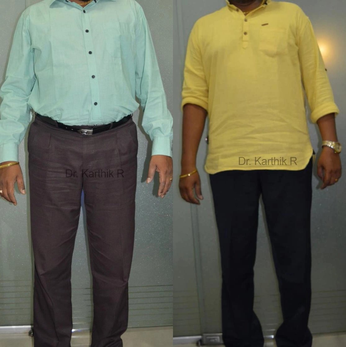 weight loss program before and after photo by chennai plastic surgery in india