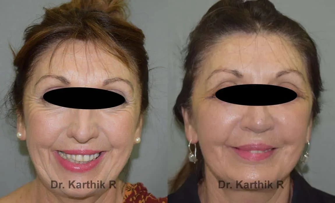 facelift before and after photo by chennai plastic surgery in india