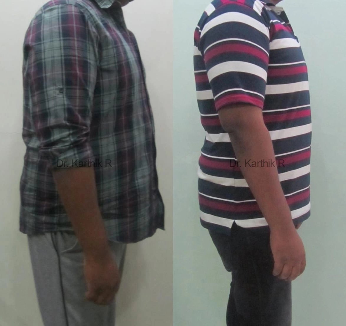 weight loss program before and after photo by chennai plastic surgery in india
