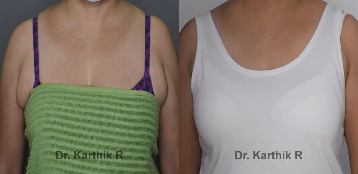 axillary tail of breast before and after photo by chennai plastic surgery in india
