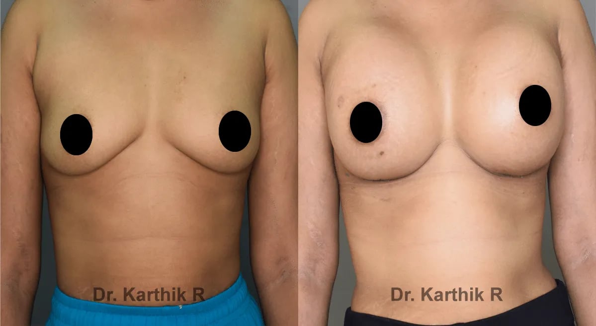 breast implants before and after photo by chennai plastic surgery in india