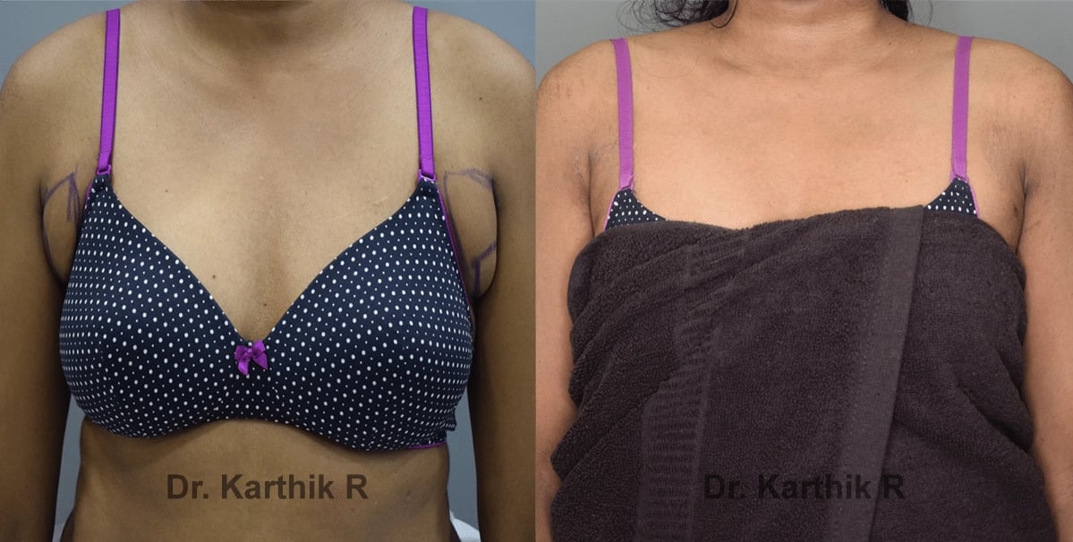 axillary tail of breast before and after photo by chennai plastic surgery in india