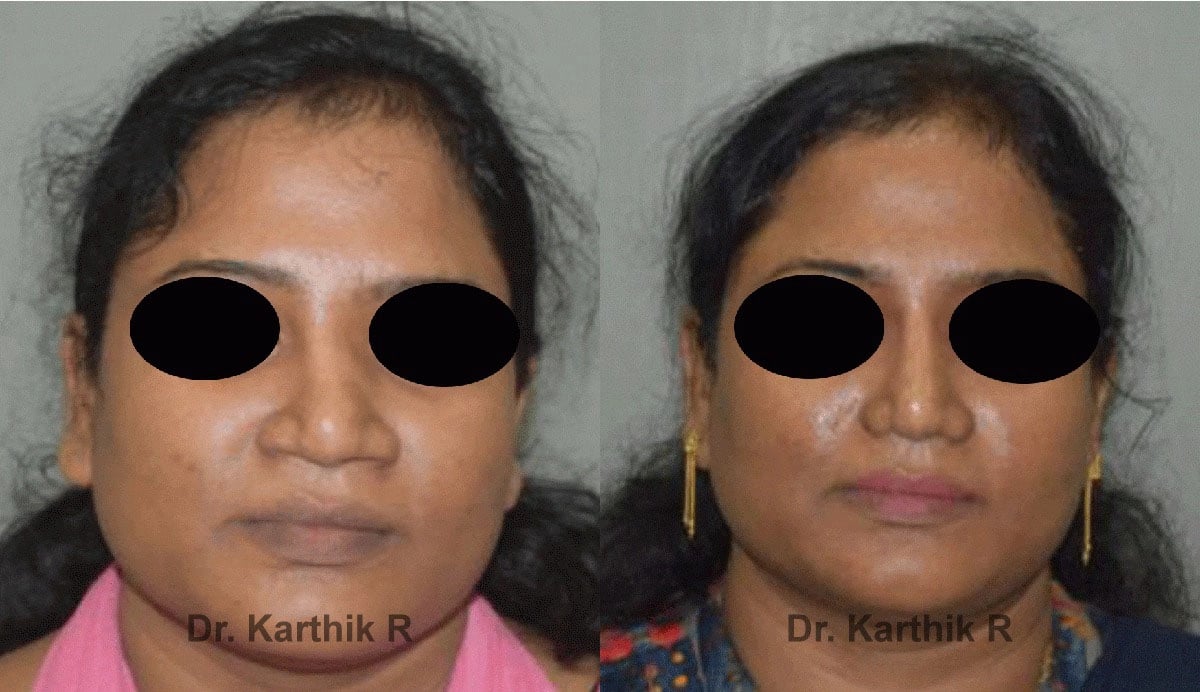rhinoplasty before and after photo by chennai plastic surgery in india
