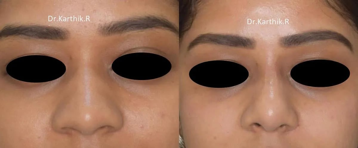 rhinoplasty before and after photo by chennai plastic surgery in india
