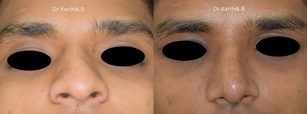 rhinoplasty before and after photo by chennai plastic surgery in india