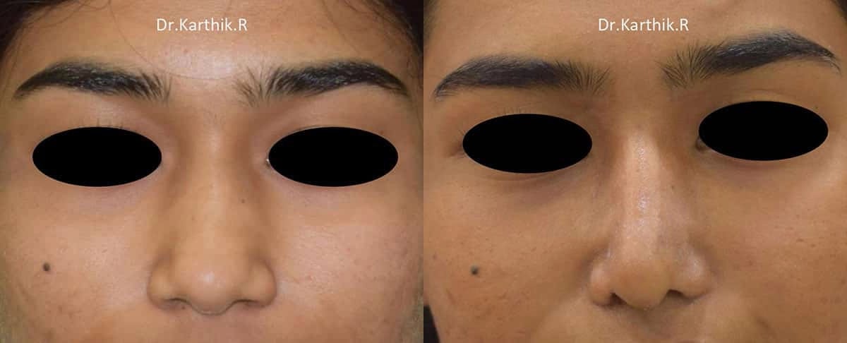 rhinoplasty before and after photo by chennai plastic surgery in india