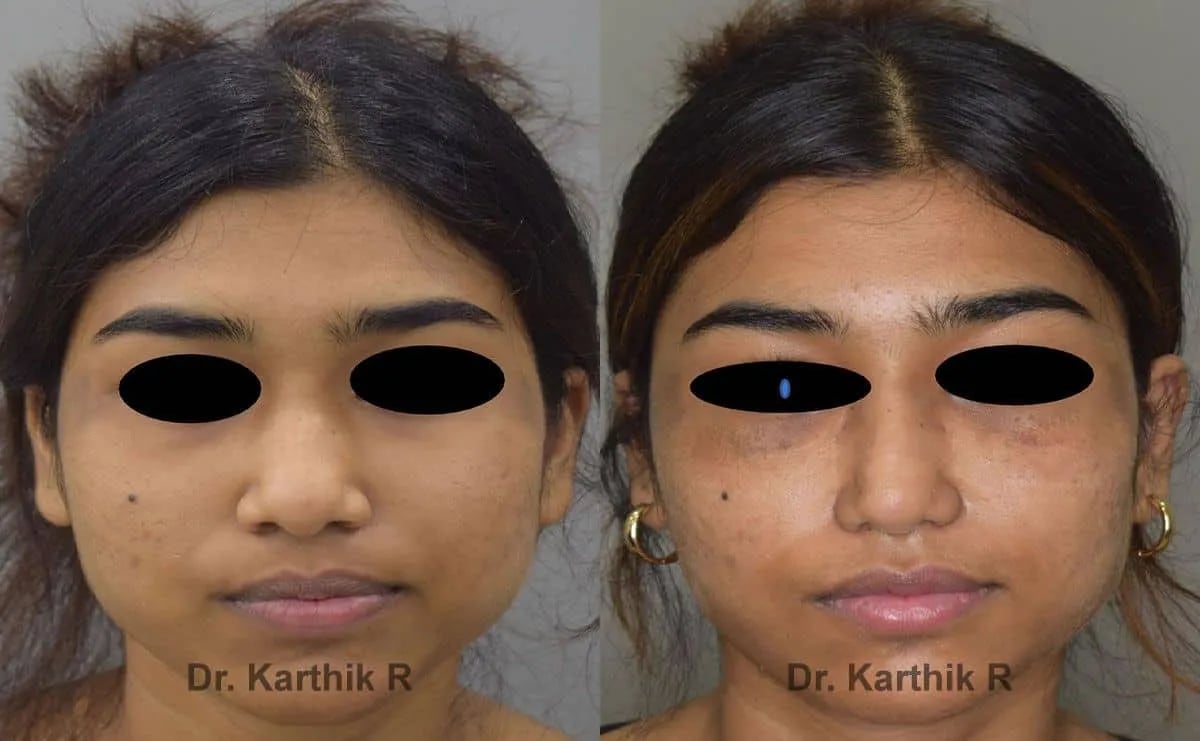 rhinoplasty before and after photo by chennai plastic surgery in india