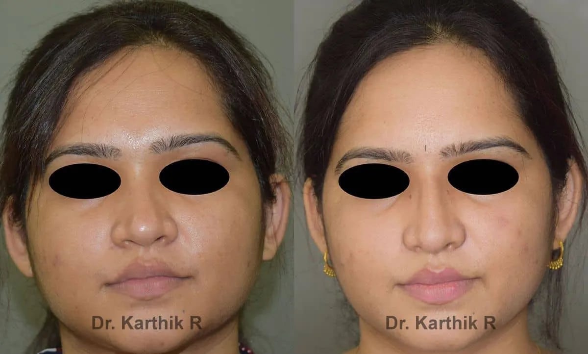 rhinoplasty before and after photo by chennai plastic surgery in india
