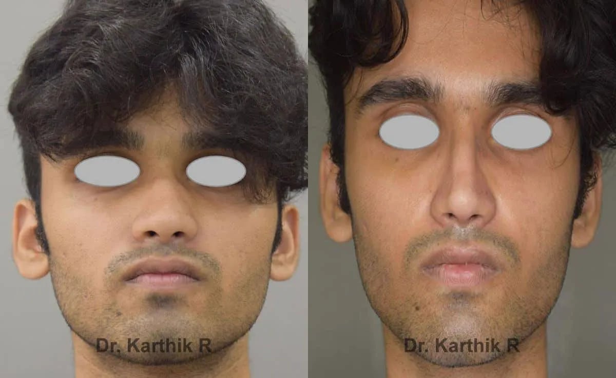 rhinoplasty before and after photo by chennai plastic surgery in india
