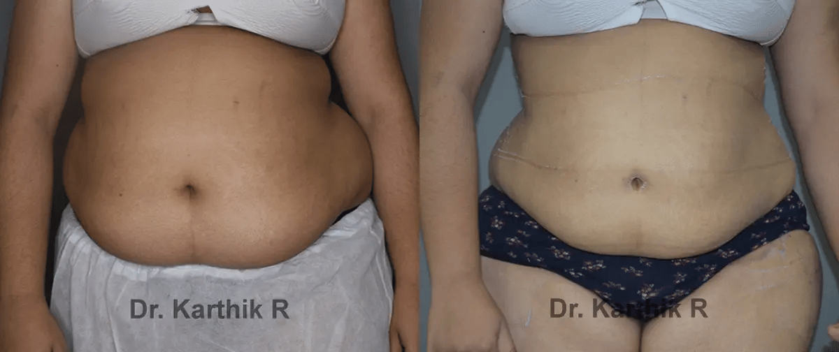 liposuction before and after photo by chennai plastic surgery in india