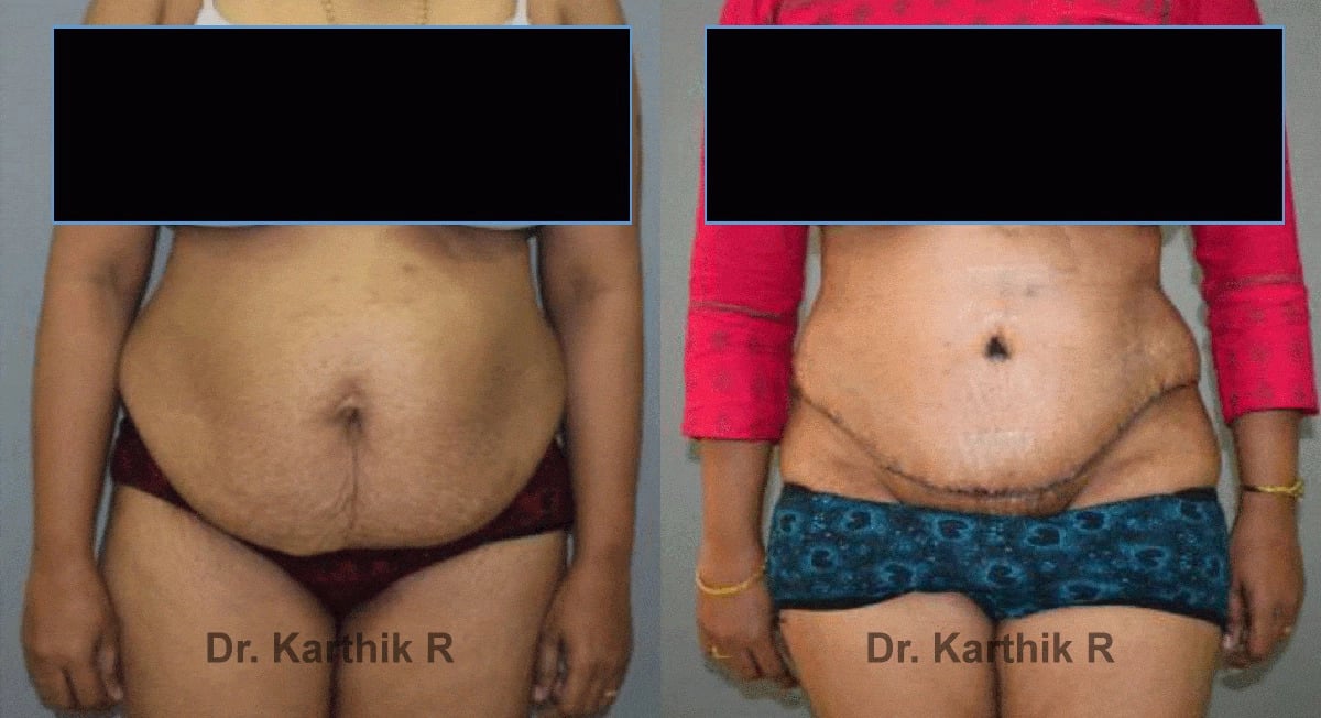 tummy tuck before and after photo by chennai plastic surgery in india