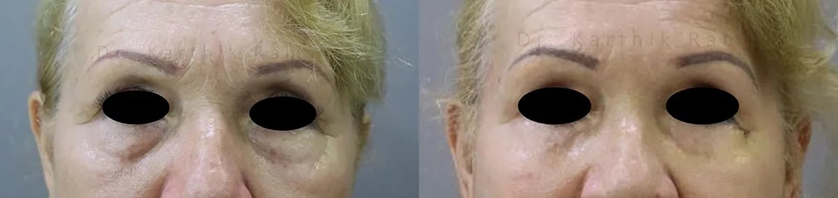 blepharoplasty before and after photo by chennai plastic surgery in india